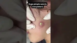 Huge pimple sqiorts everywhere ?