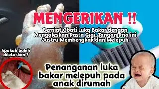 Pertolongan Pertama Luka Bakar di Rumah || Kena Knalpot