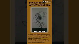 Basilar artery aneurysm