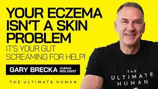 Why Your Eczema Isn’t Just Skin Deep...Here’s the REAL Cause! | TUH 
