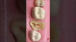 Last Hope of Saving this Tooth! 