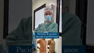 😱Lipohd pré e pós paciente de 59anos