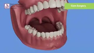 NDCS Gum Surgery (Live Action + 3D Animation)