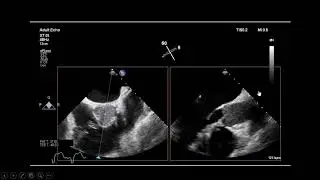 Aortic stasis / Thrombosis, an ECMO complication