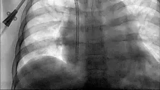 Permacath for Dialysis Interventional Radiology