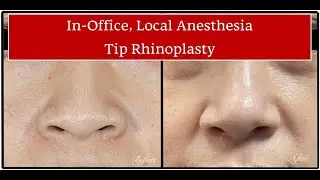 Tip rhinoplasty--local anesthesia, in-office, wide awake