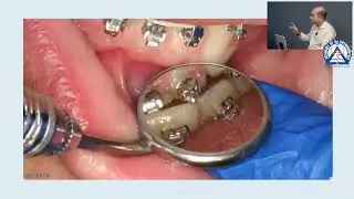 Monday Tip: How to Assess the Overjet when Closing Orthodontic Spaces!