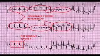 ЭКГ номер 6 - заключение, клиническая интерпретация и что делать