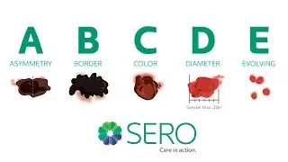 Do You Know the ABCDE of Skin Cancer? | SERO