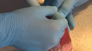 ушивание ран сердца русс