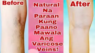 Natural Na Paraan Kung Paano Mawala Ang Varicose Veins! Alamin Natin!