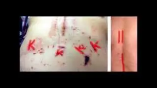Disabled Blind Man Branded KKK Back & Front