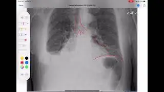 Pleural effusion and pneumonia on CXR, ultrasound