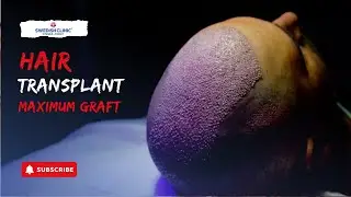 Hair Transplant Maximum Graft 2024