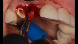 What Does a Tooth Abscess Look Like? (Tissue After an Extraction)