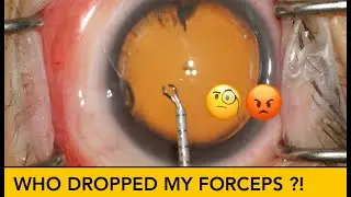 Broken MST Forceps | Fixing them during Cataract Surgery