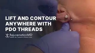 Using PDO Threads for a Neck Lift