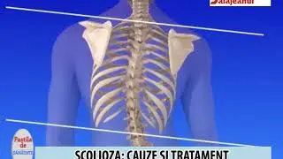 PASTILA DE SANATATE   SCOLIOZA CAUZE SI TRATAMENT
