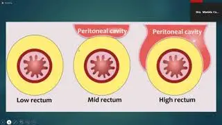EVALUACIÓN DEL RECTO POR RESONANCIA MAGNÉTICA