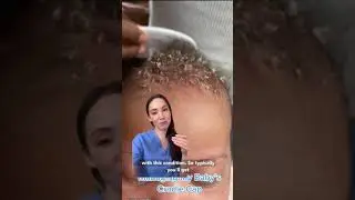 How to Treat Seborrheic Dermatitis