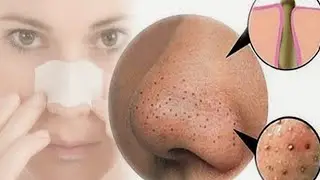 Как Убрать Черные Точки На Носу