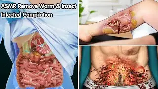 ASMR Remove Worm & Insect Infected Compilation - Deep Cleaning Animation