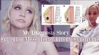 my rare diagnosis story: superior mesenteric artery syndrome
