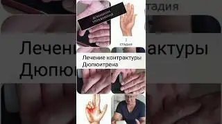 Dupuytren's Contracture Treatment: Home Exercises