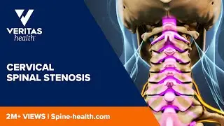 Cervical Spinal Stenosis