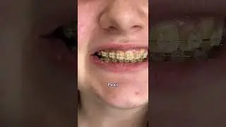 Braces Colors Before and After 8 weeks