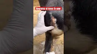 Hygroma of knee l dr Umar khan