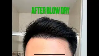 Hair Styling after a Hair Transplant - Motion Hair Clinic, Gangnam