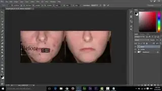 How to Remove Pimples in Adobe Photoshop CC