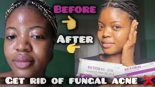 How I Cleared My Fungal Acne in 7 Days!!!😱 (Malassezia Safe Routine) #HowToGetRidOfFungalAcne