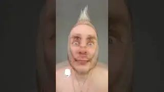 2 года после блефаропластики.