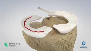 Meniscus suturing