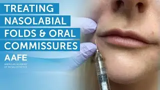 Using Dermal Fillers to Fill and Smooth Smile Lines! | AAFE
