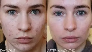ROACCUTANE MONTH 6 - Update & Daily Skin Vlog!