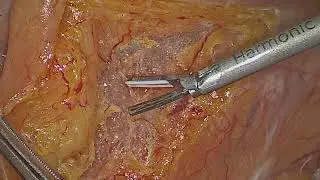 Transabdominal Minimal Invasive Surgery: Intersphincteric Dissection with Preserved Hiatal Ligament