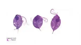 TRICOMONÍASE VAGINAL