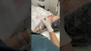 Биоревитализация со Скинопро Актив #shortvideo #косметология #обнинск #обнинск