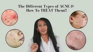 Different Types of Acne | How to Treat Them Each Acne Types