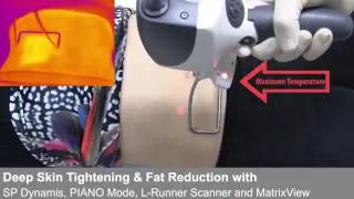 Láseres Fotona - TightSculpting
