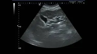 Advanced LC with splenomegaly