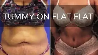 Tummy Tuck and Brazilian Butt Lift For Sexy Curves