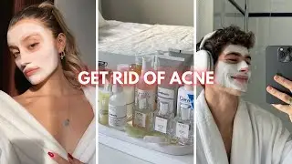 Say Goodbye to Acne: Your Ultimate Guide to Clear Skin!