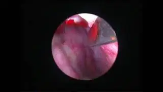 Epistaxis Angiome du Méat Inférieur Droit