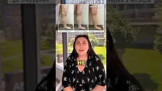 Відгук про варикоз