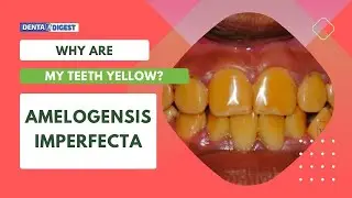 YELLOW TEETH : AMELOGENSIS IMPERFECTA. KNOW WHY YOUR TEETH ARE YELLOW.