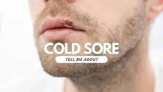 Cold Sores
